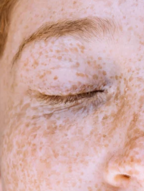 Cuidado Localizado para Manchas Oscuras, Ácido Kójico al 1 %